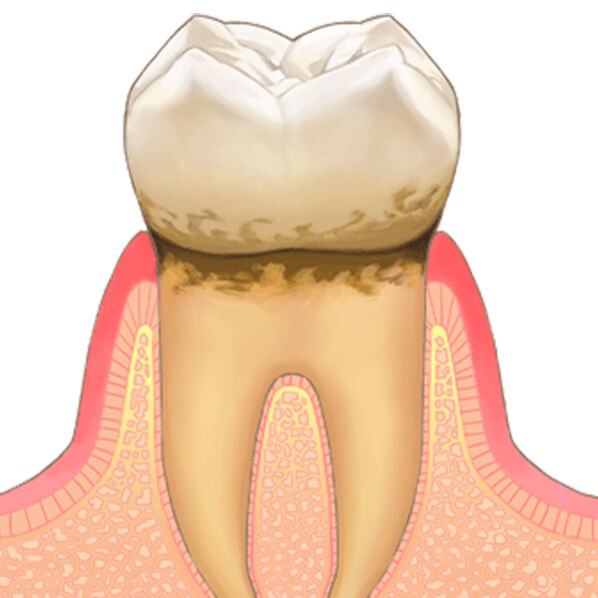 軽度歯周病