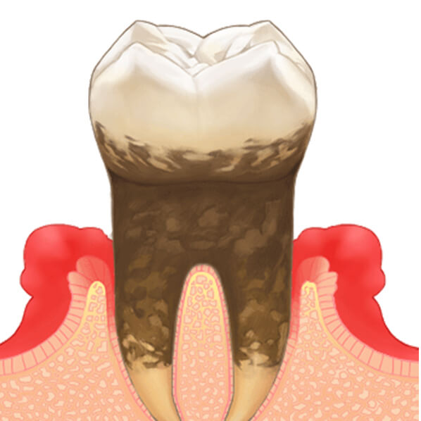 重度歯周病
